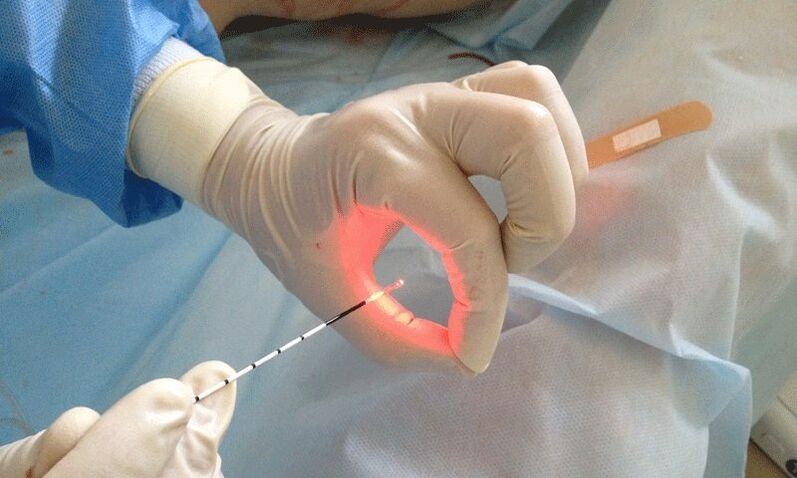 Laserbehandlung bei Prostatitis